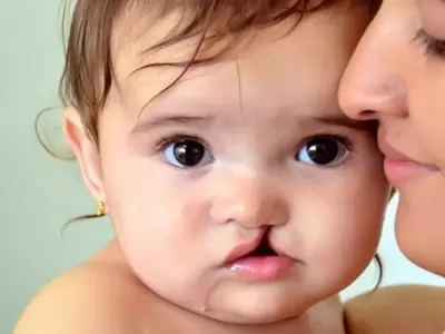 Beb con labio leporino y su madre.